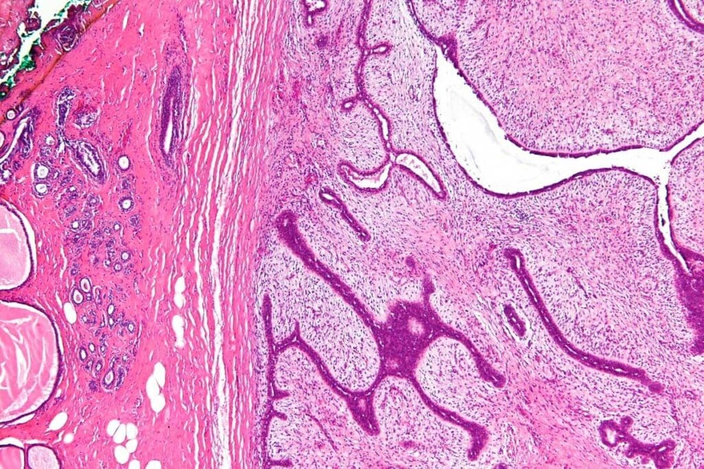 Muscle Tissue Tumor Medical Term: Are Sarcomas Always Malignant?