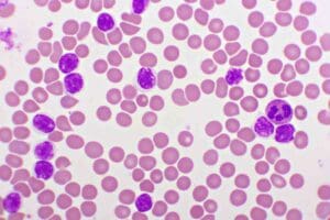 Leukaemia Remission: What Blast Cells in Blood Indicate
