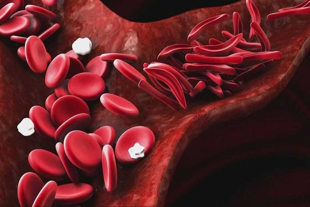 Can Blood Type O Have Sickle Cell Anemia? Key Facts
