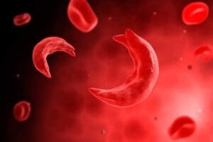 Can Blood Type O Have Sickle Cell Anemia? Key Facts
