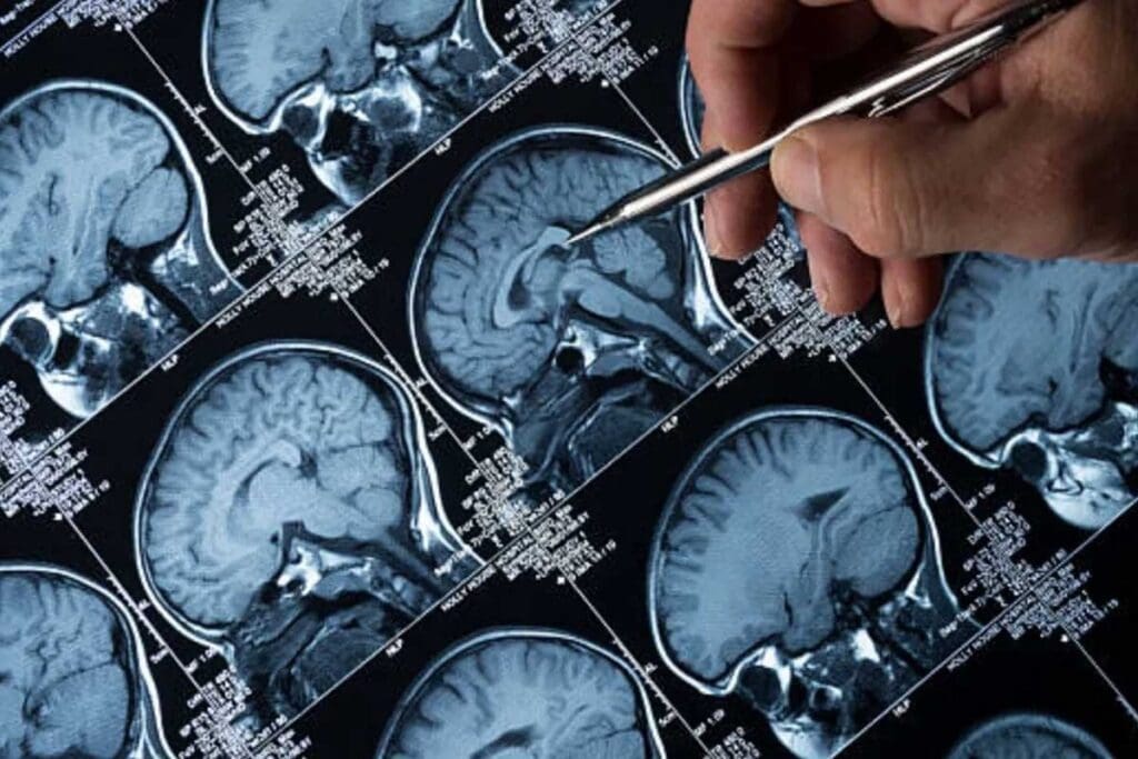 What Causes a Brain Tumor to Form in Adults?