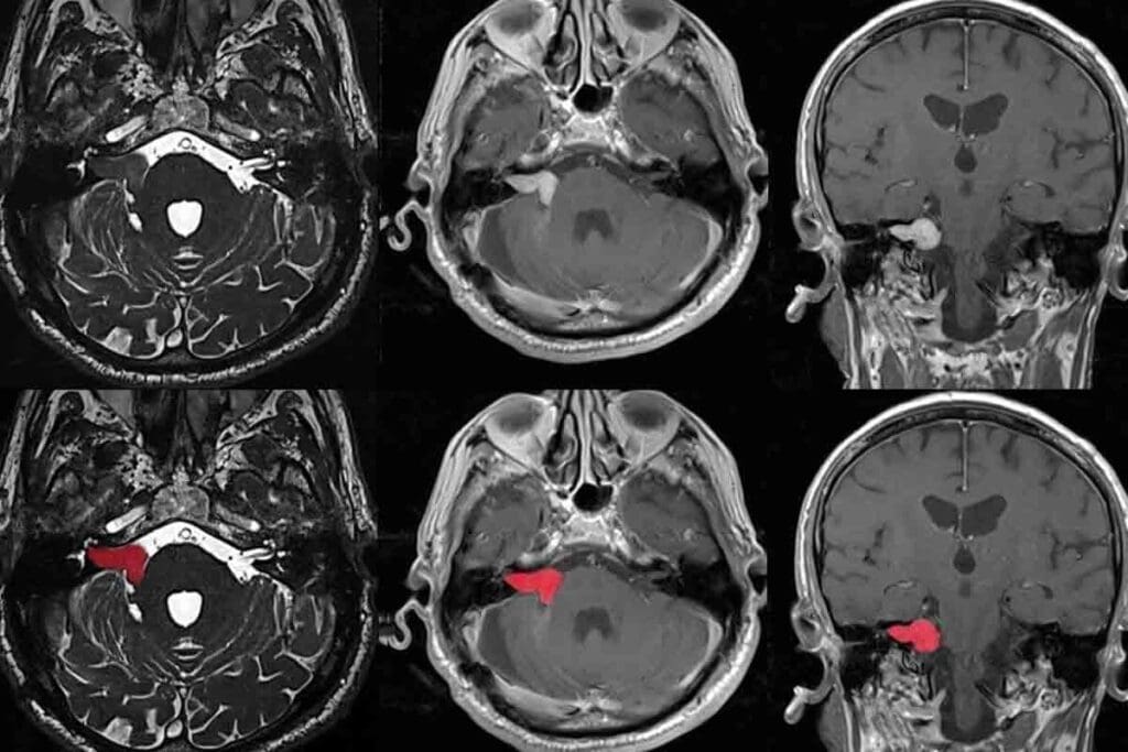 Tumor on Brain Stem Symptoms: 12 Key Signs by Location