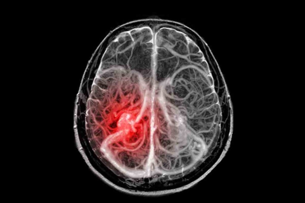 What Causes Brain Tumor in Adults? Key Risks Explained 1 What Causes Brain Tumor in Adults? Key Risks Explained