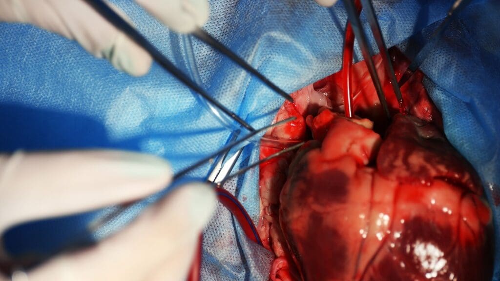 What Is Cardiac Ring Surgery for Vascular Rings in Infants and Is It Dangerous?