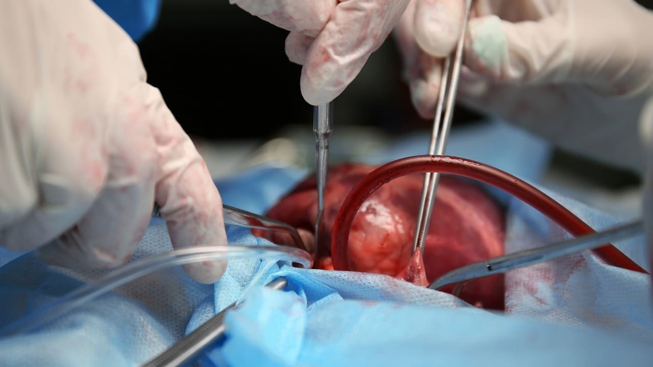 7 Facts About Heart Ring Operation: Types, Procedures, and Recovery