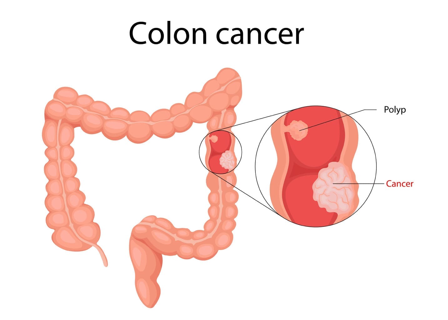 What Is the Difference Between Colon Cancer and Prostate Cancer?