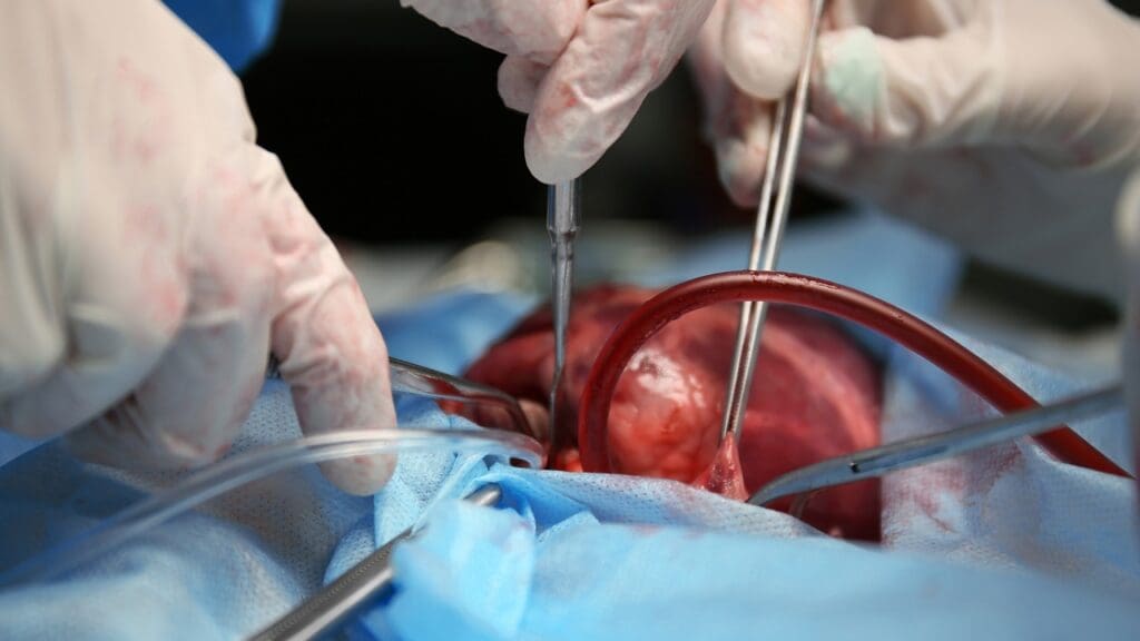 cardiac valve repair surgery