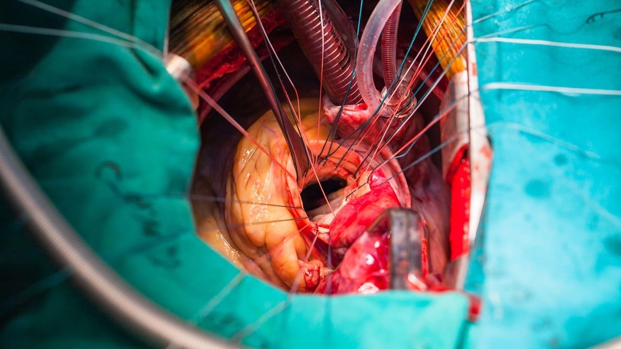Heart Valve Repair Surgery: 7 Key Facts About Cardiac Valve Replacement