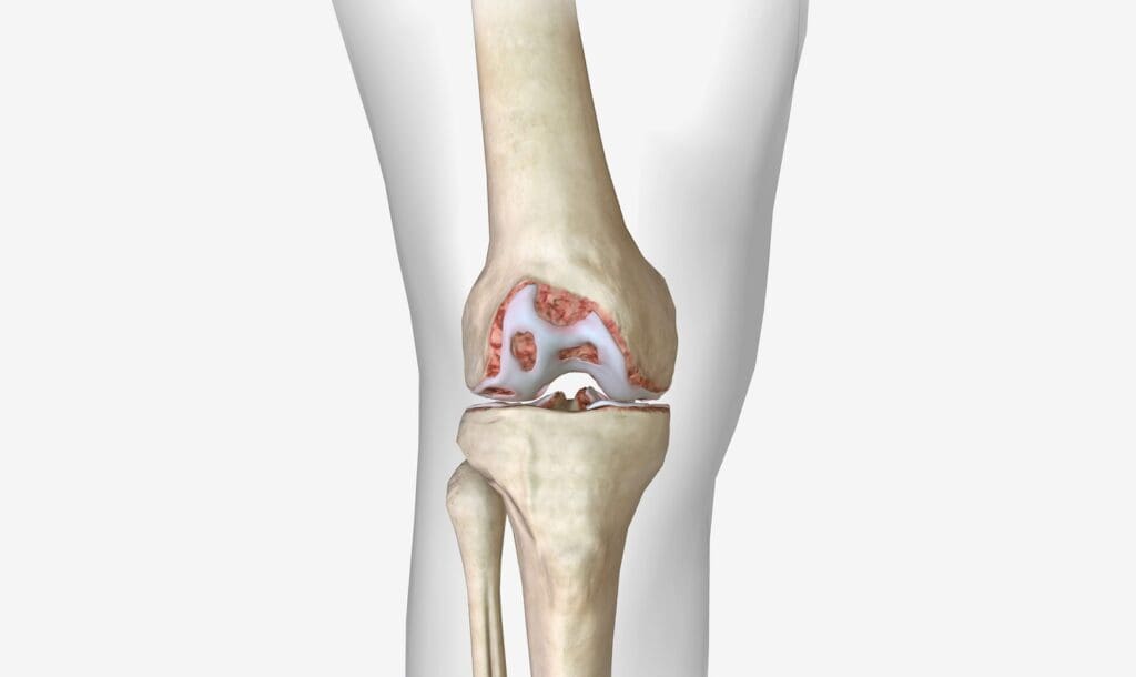 A detailed anatomical illustration of a partial tear in the anterior cruciate ligament (ACL) of the human knee joint