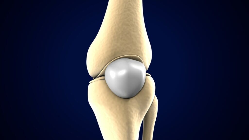 A detailed medical diagram showcasing the anatomy of a partial anterior cruciate ligament (ACL) tear.