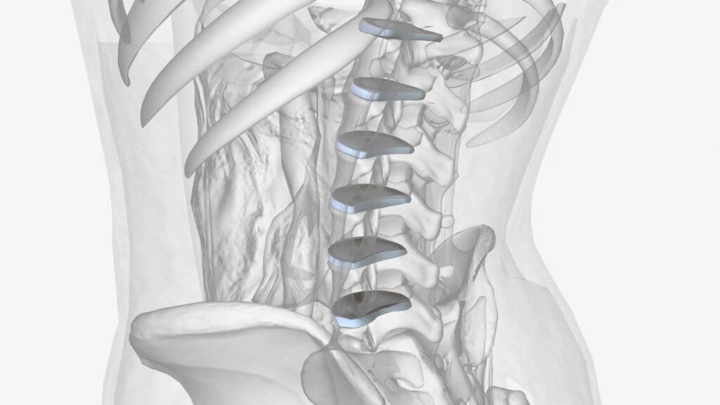 A high-resolution, photorealistic image of a spinal fusion surgery in progress A high-resolution, photorealistic image of a spinal fusion surgery in progress