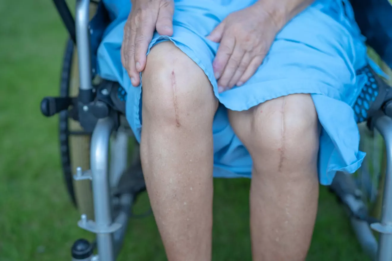 How Often to Ice After Knee Replacement: 7 Essential Recovery Tips 1 How Often to Ice After Knee Replacement: 7 Essential Recovery Tips