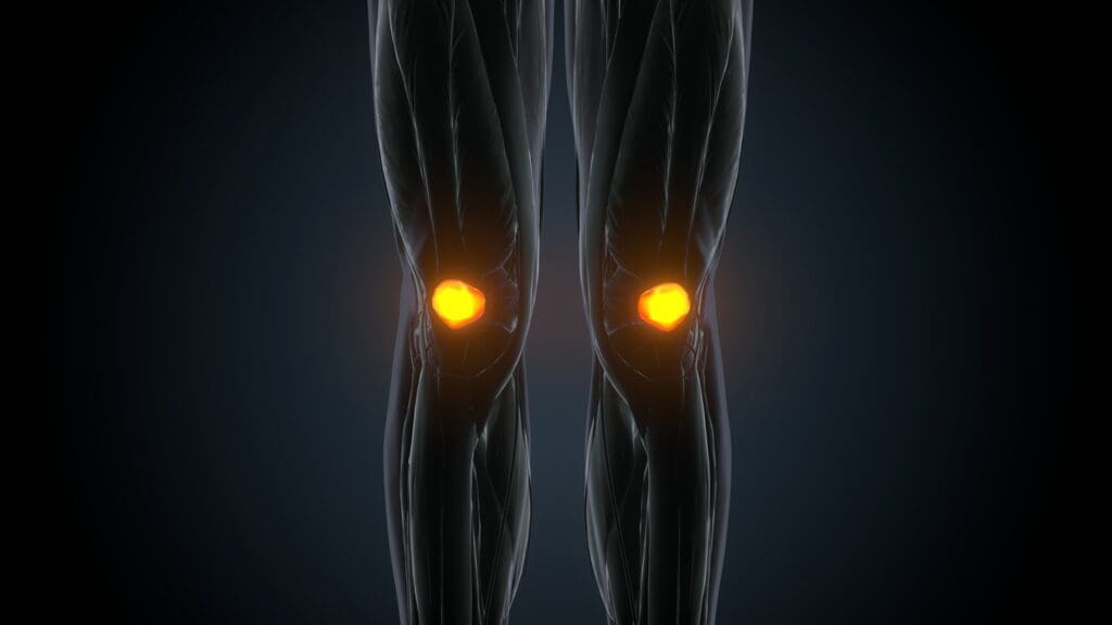 a partially replaced human knee joint