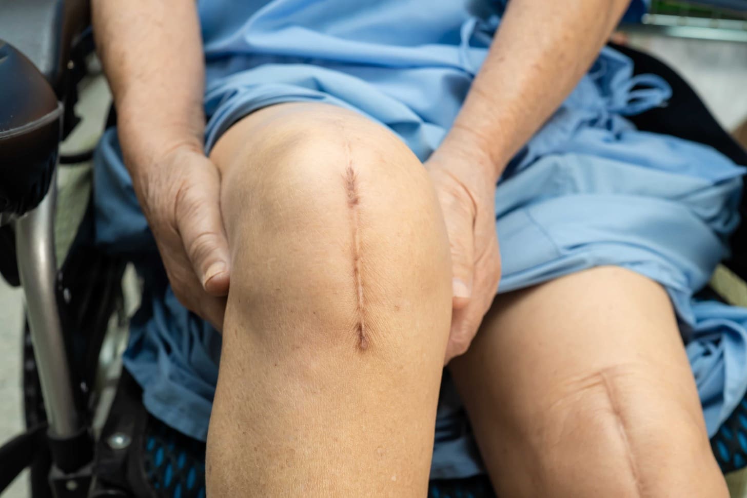 7 Key Things to Know About Your Partial Knee Replacement Scar