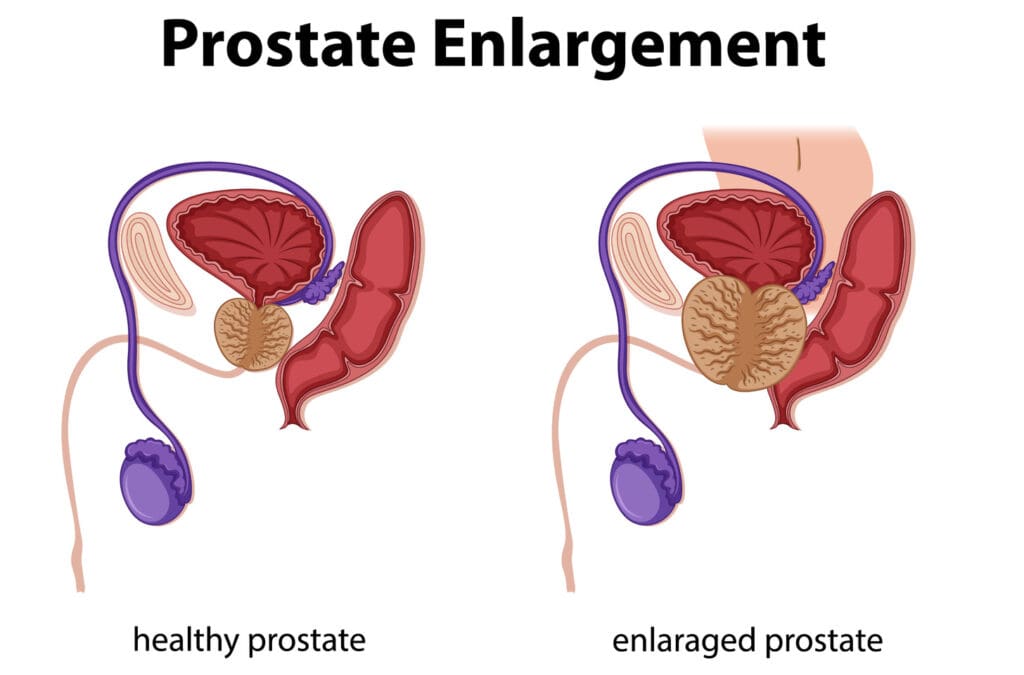prostate health
