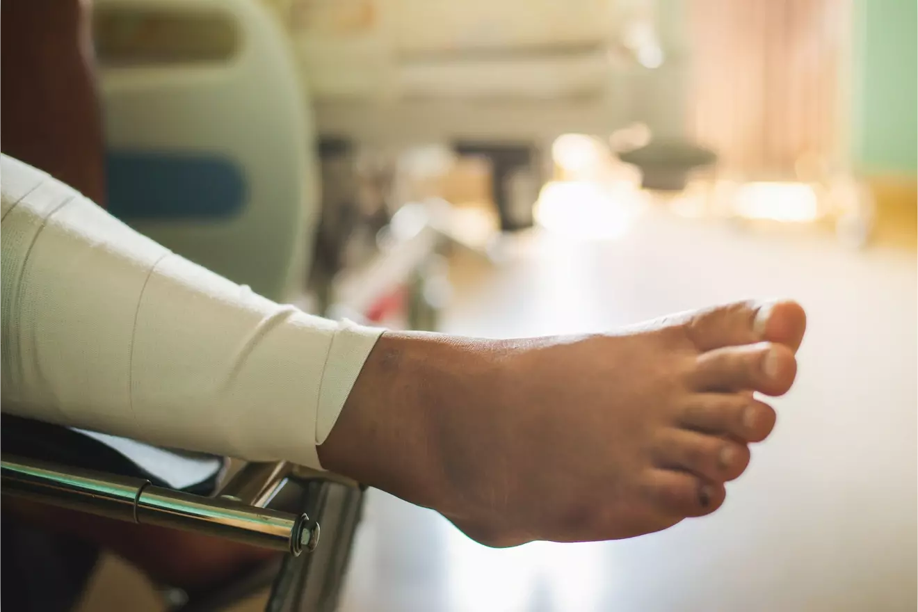 post bunion surgery recovery