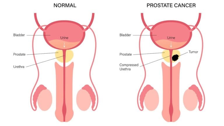What Happens If a Man Lives Without a Prostate Gland?