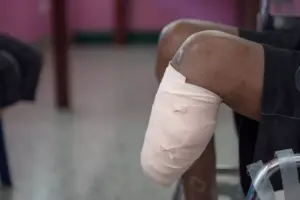 How Long Is ACL Surgery Recovery Time? Key Timelines & Walking Milestones