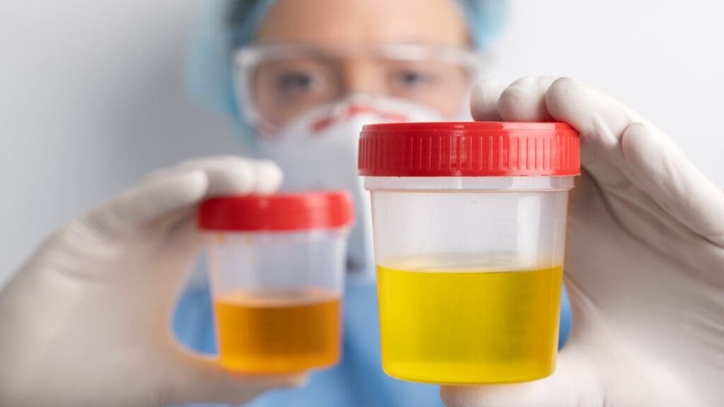 Blood in Urine After Prostatectomy: 7 Key Causes & What You Should Know