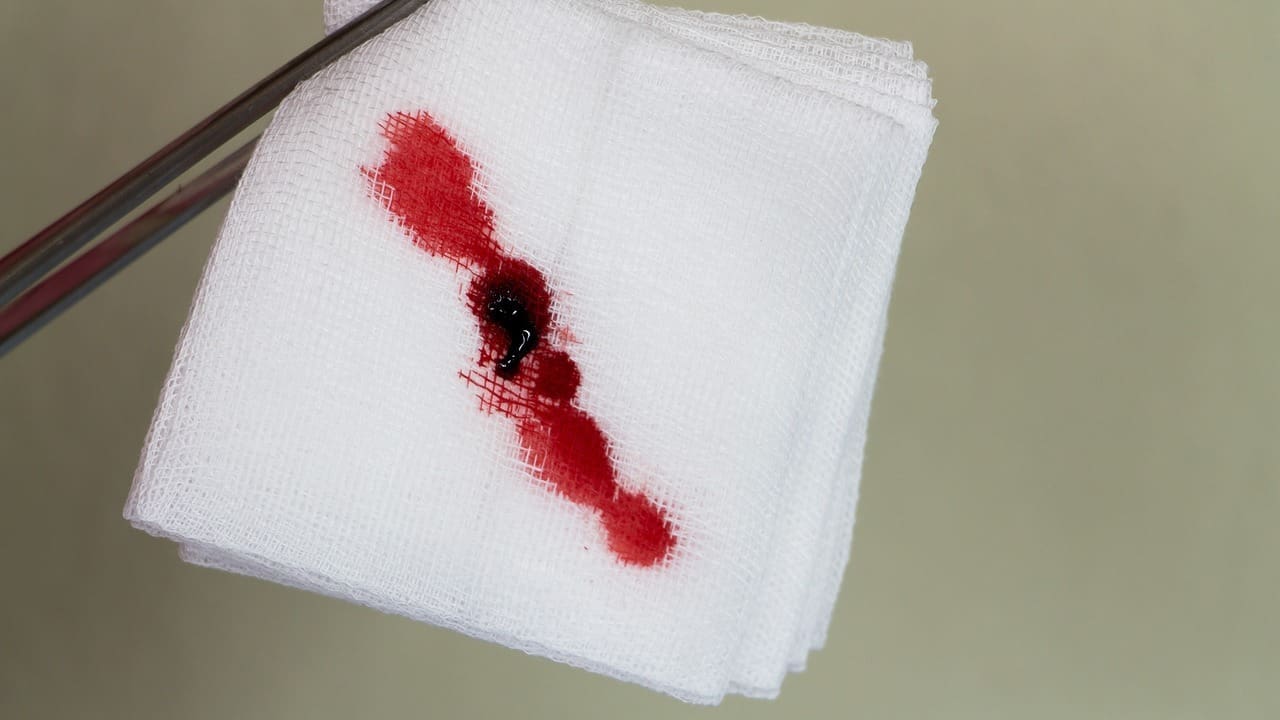 How Long Do Blood Clots and Bleeding Last After Green Light Laser Prostate Surgery? 1 How Long Do Blood Clots and Bleeding Last After Green Light Laser Prostate Surgery?