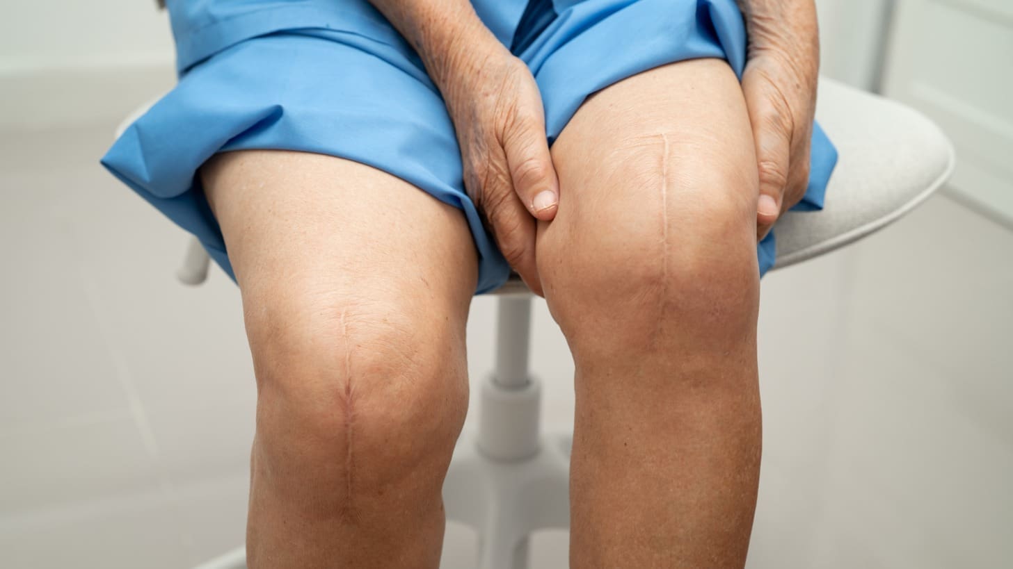 osteoarthritis LIV Hospital