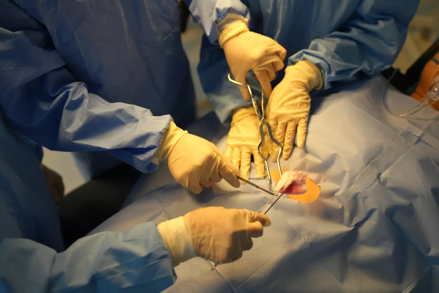 How Does Keyhole Bypass Surgery Compare to Traditional CABG in Recovery, Procedure, and Risks?