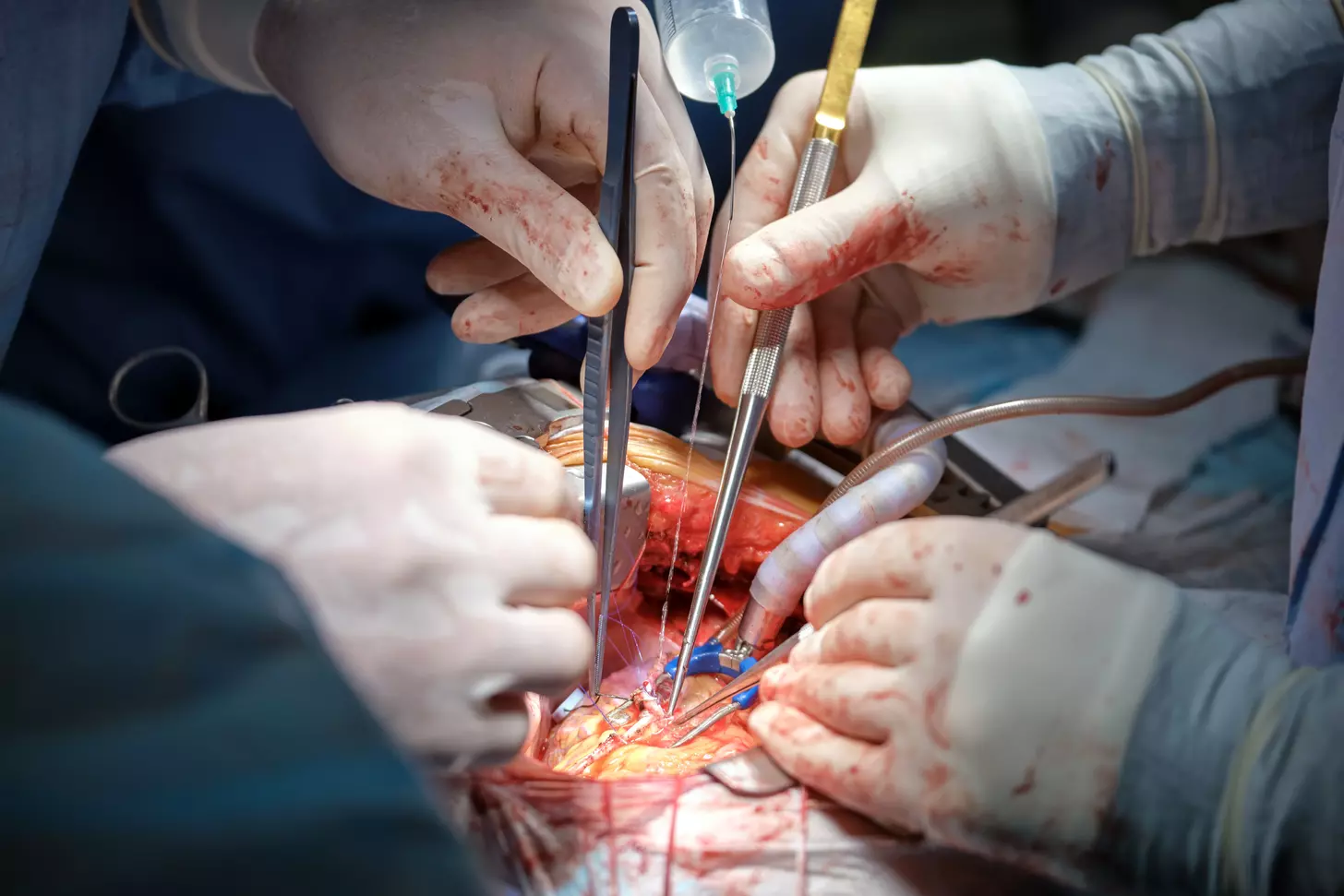 How Serious Is Triple Bypass Heart Surgery and What Are Its Survival Rates?