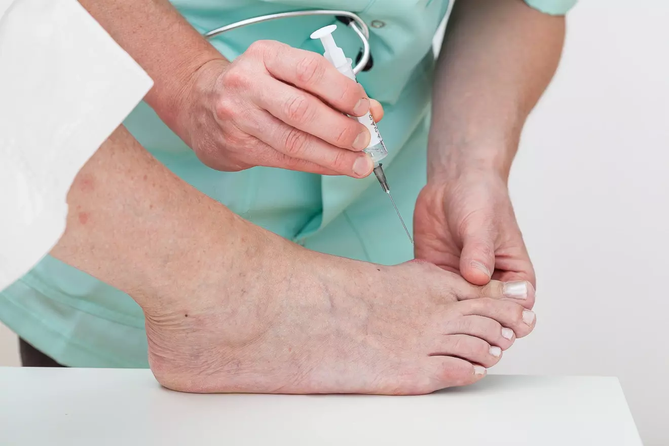 Recuperation from Bunion Surgery: 7 Key Facts About Minimally Invasive Recovery