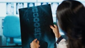 How Long Do Spinal Fusions Last and What Can You Expect Years Later?