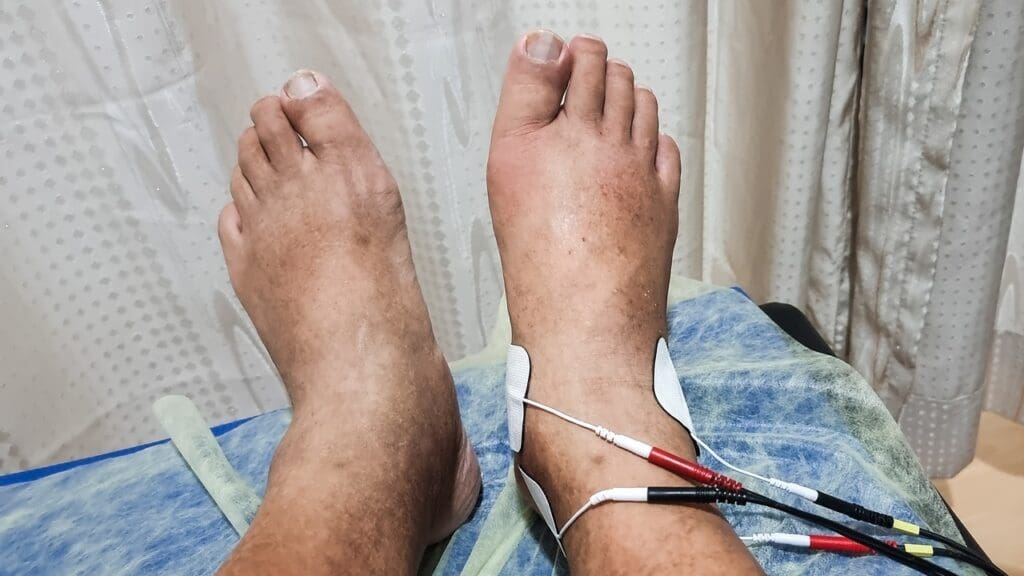 nerve pain in foot after back surgery