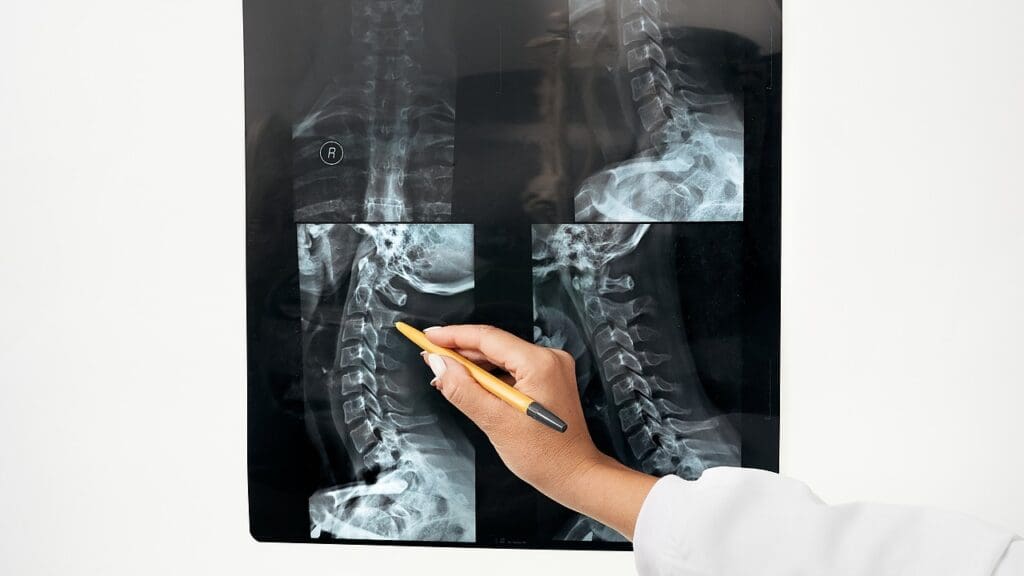 lumbar bone fusion definition