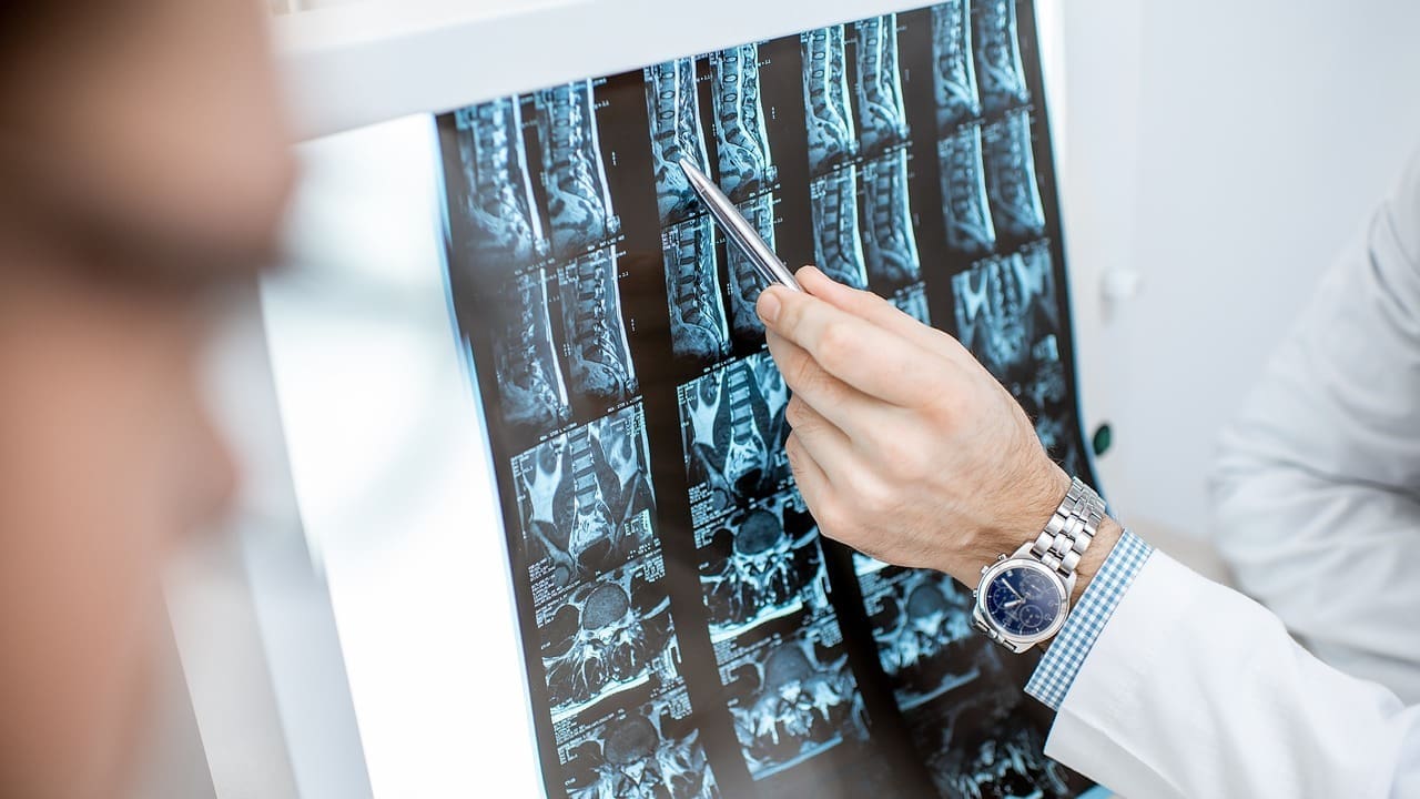 When Is Spinal Fusion Necessary—and Is Back Surgery Worth It?