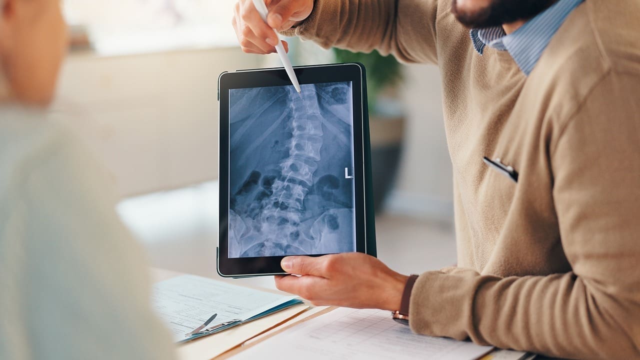 Common Problems After Spinal Fusion: 12 Key Issues and Symptoms Explained 1 Common Problems After Spinal Fusion: 12 Key Issues and Symptoms Explained