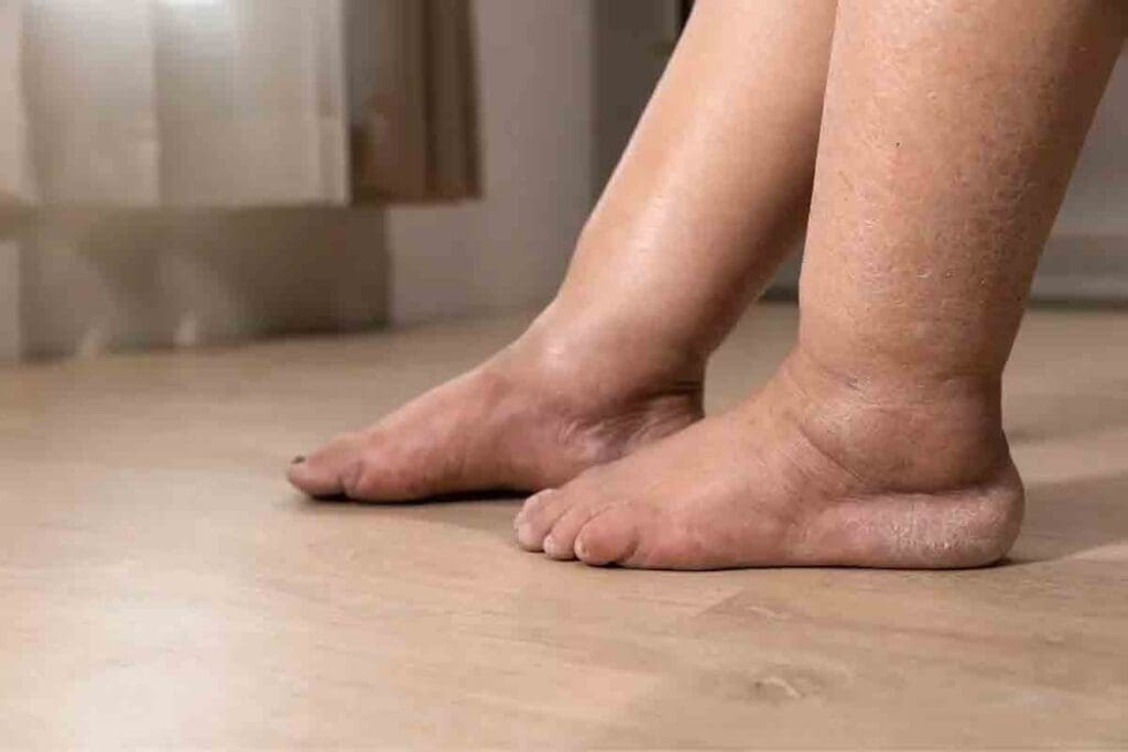 Anemia Leg Swelling: Crucial Causes of Edema Explained 1 Anemia Leg Swelling: Crucial Causes of Edema Explained