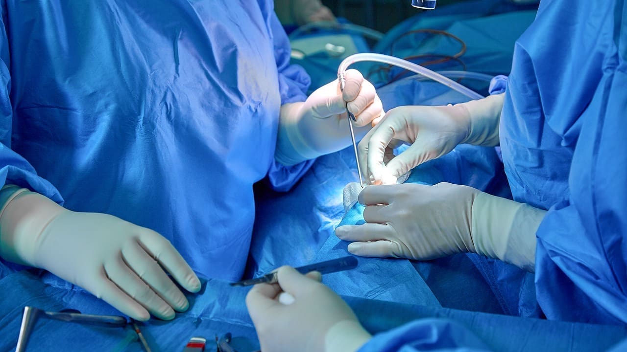 How to Take Out an Appendix: Step-by-Step Guide to Laparoscopic Appendectomy