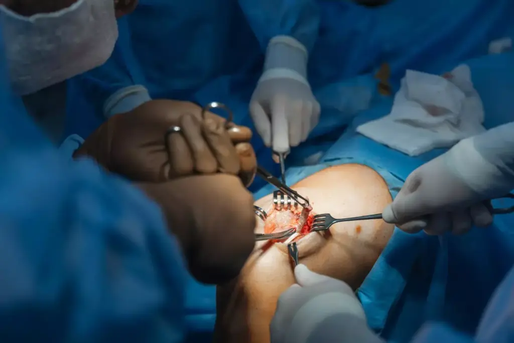A detailed, close-up view of a surgical procedure on a patient's knee joint. The foreground shows the doctor's hands precisely operating on the exposed knee, with surgical tools and implants visible. The middle ground reveals the patient's leg positioned on the operating table, surrounded by a sterile, well-lit medical environment. In the background, the surgical team and advanced medical equipment contribute to the technical and professional atmosphere. The scene conveys the complex, delicate nature of the total knee replacement surgery, with a focus on the intricate, meticulous steps involved.