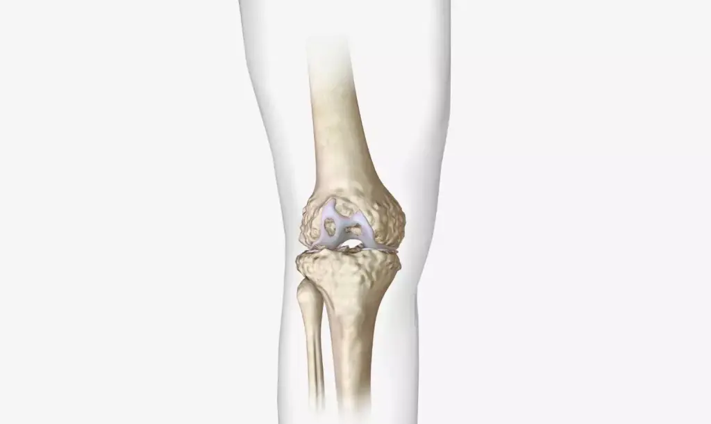 Detailed cross-section of an osteoarthritic knee joint, with the degenerative cartilage and bone structure clearly visible. Crisp medical illustration style, with muted, clinical colors and soft, shadowless lighting to emphasize the anatomical features. Focus on the joint space narrowing, osteophyte formation, and subchondral bone sclerosis, key hallmarks of the disease. Depict the gradual breakdown of the joint, revealing the underlying skeletal structure in a way that educates and informs the viewer about the pathology of osteoarthritis. Convey a sense of scientific objectivity and clinical precision, without any distracting background elements.