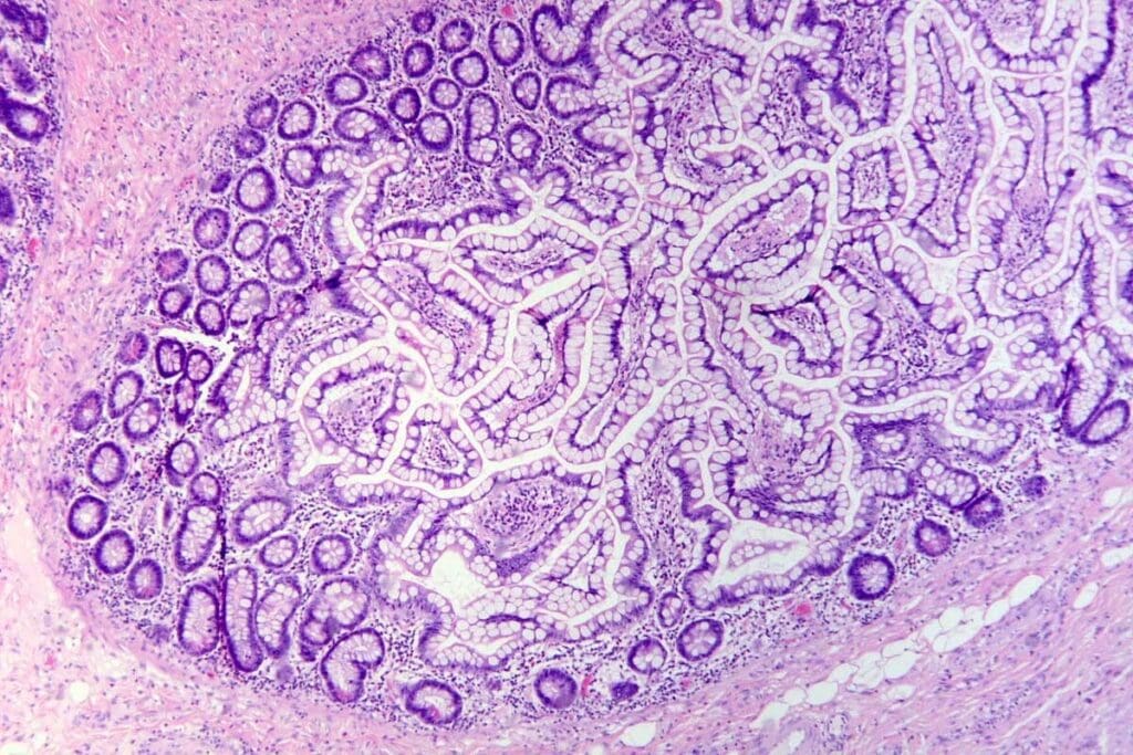 What Is The Cause Of Acute Lymphoblastic Leukemia: Key Risks 1 What Is The Cause Of Acute Lymphoblastic Leukemia: Key Risks