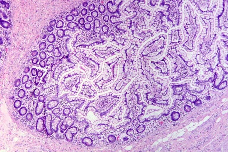 What Is The Cause Of Acute Lymphoblastic Leukemia: Key Risks