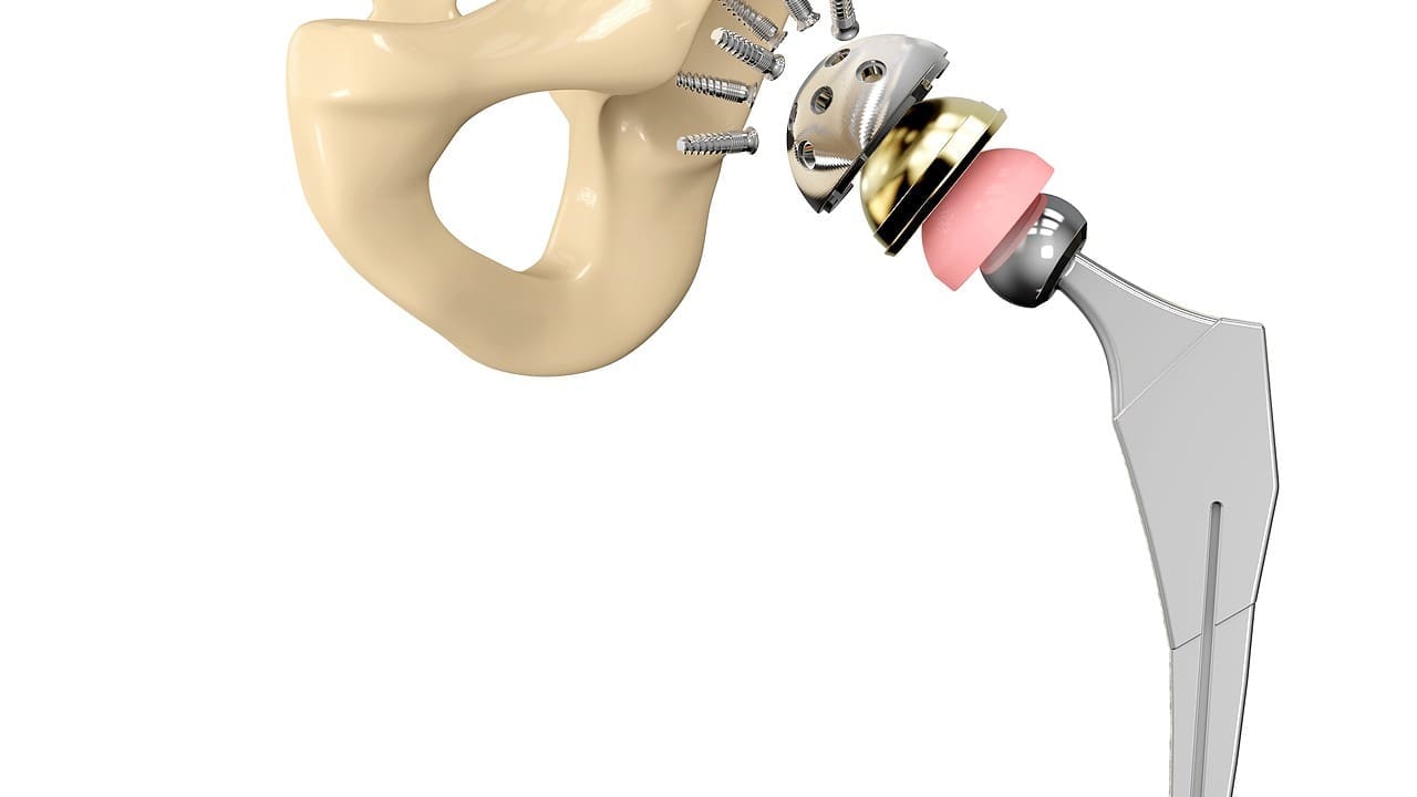 Hip Implant Parts Explained: 4 Essential Components of Total Hip Arthroplasty