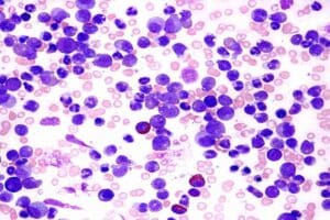 Pediatric Acute Myelogenous Leukemia: 7 Key Facts