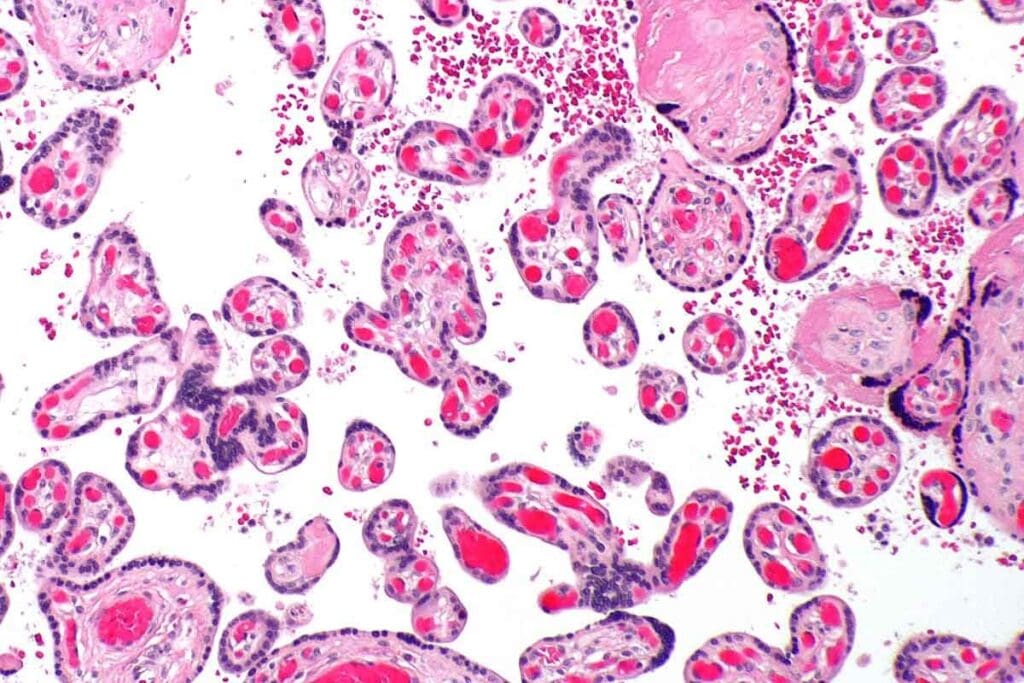 7 Key Facts About Marrow Hypoplasia: Causes, Symptoms, and Treatment