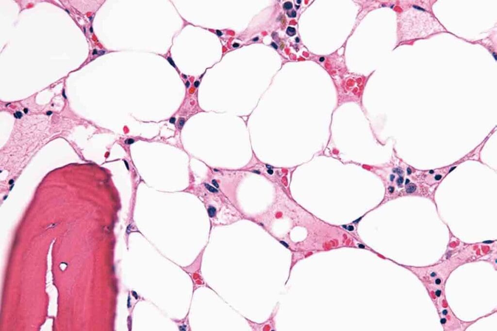 Aplastic Crisis Vs Aplastic Anemia: Key Differences Explained 2 Aplastic Crisis Vs Aplastic Anemia: Key Differences Explained