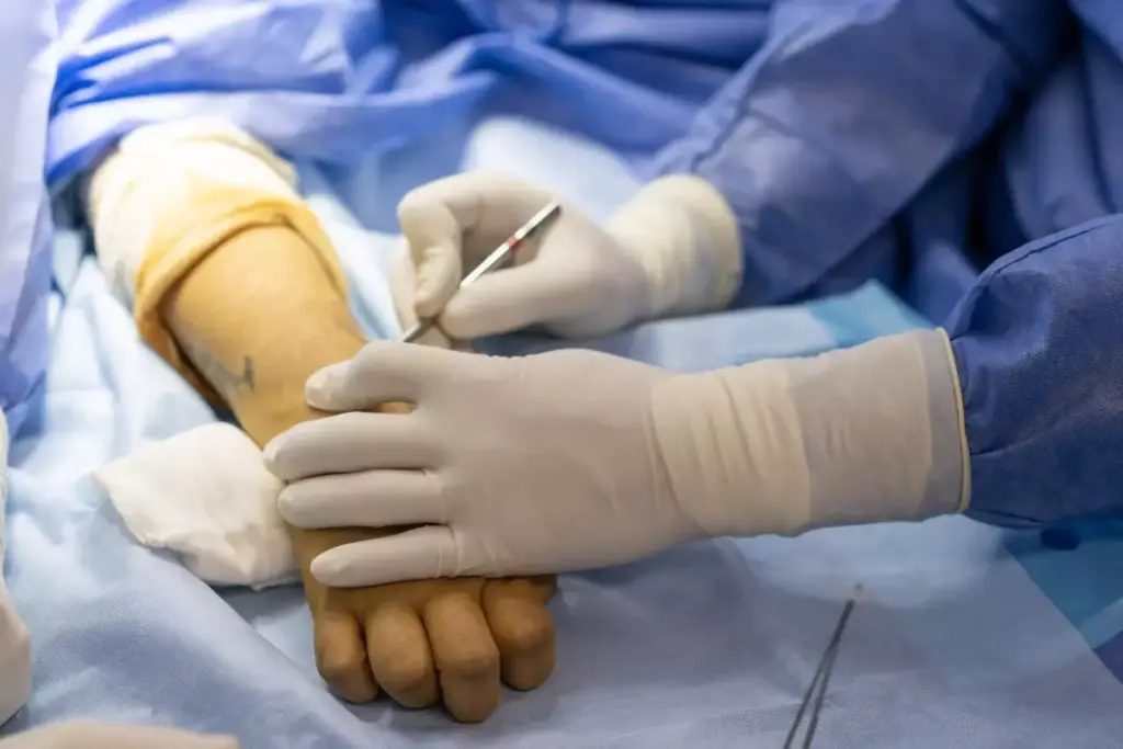 A detailed surgical scene depicting the carpal tunnel release procedure. The foreground shows a surgeon's hands carefully dissecting the transverse carpal ligament, revealing the median nerve. The middle ground features surgical instruments, including a scalpel and retractors, used to meticulously expose the anatomy. The background showcases the sterile surgical environment, with bright overhead lighting and a blurred medical team in the periphery. The overall mood is one of clinical precision and focus, conveying the technical expertise required to successfully perform this delicate operation.