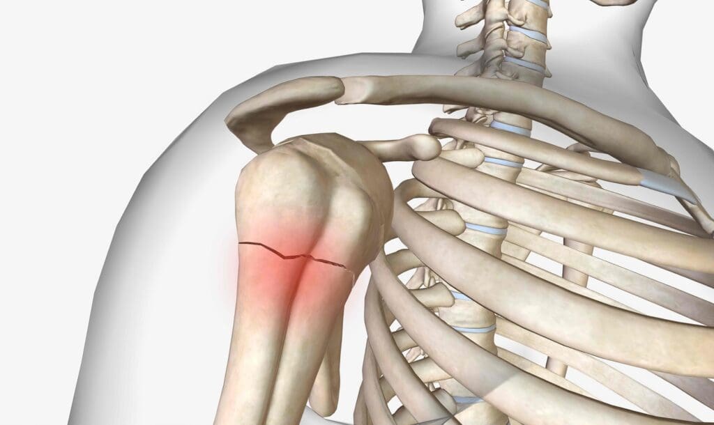 A highly detailed 3D illustration of total shoulder arthroplasty components