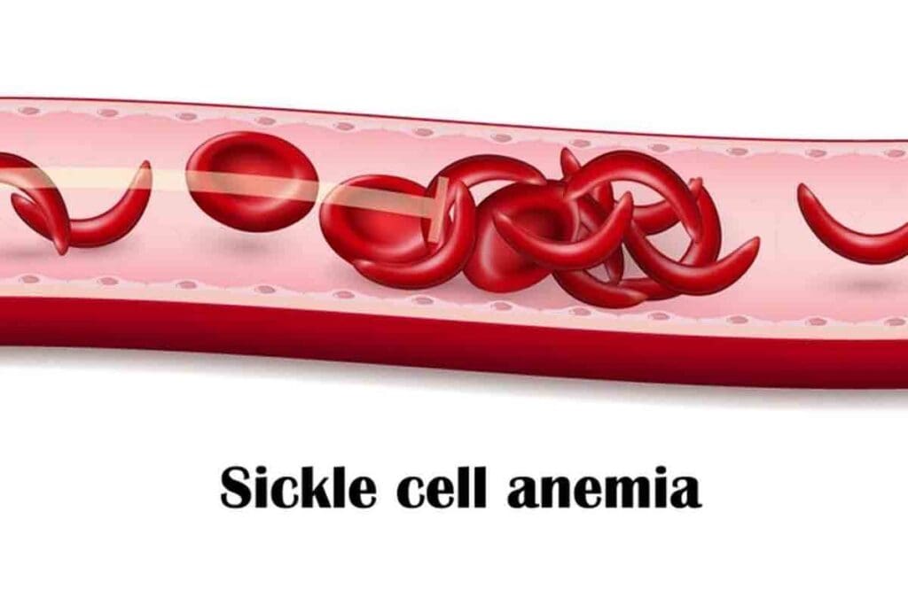Aplastic Crisis: Key Difference from Aplastic Anemia