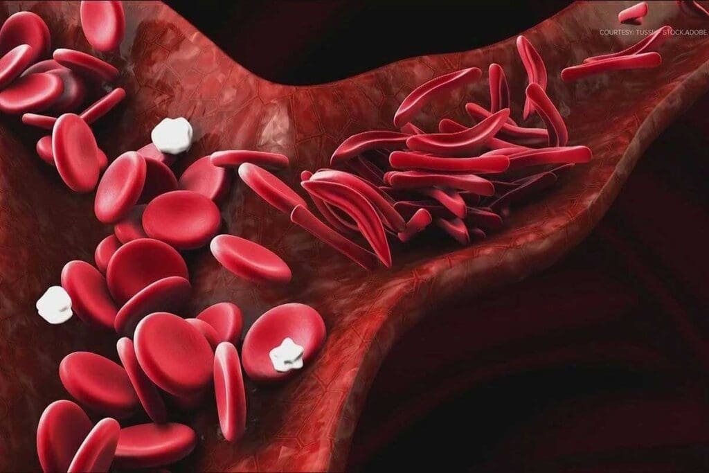 Inherited Anaemia: 7 Key Genetic Types to Know
