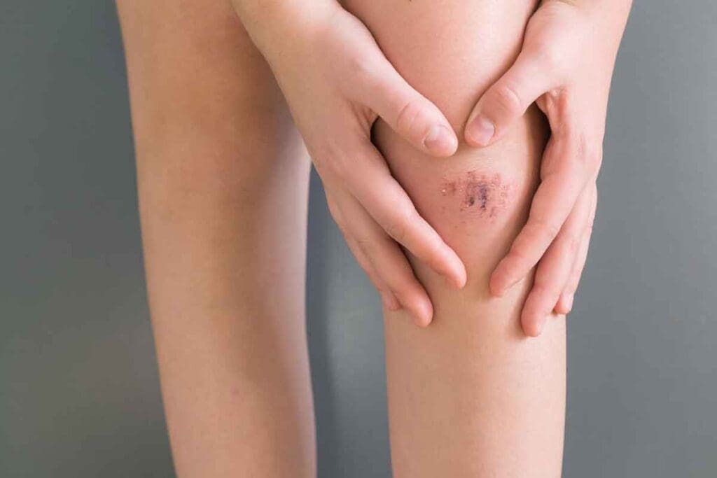 6 Key Differences Between a Bruise and a Blood Clot: Does a Blood Clot Look Like a Bruise