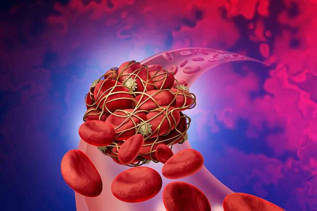 How Do Blood Clots Resolve on Their Own and When Is Medical Treatment Needed?