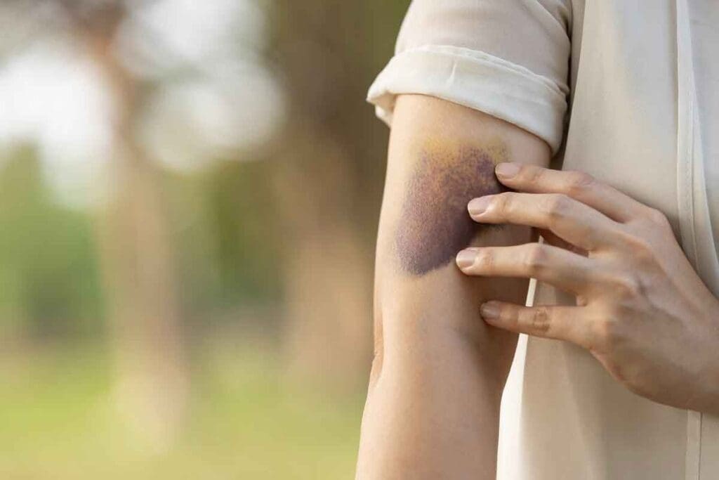 Do Blood Clots Look Like Bruises? How Can You Tell the Difference Between a Blood Clot and a Bruise?